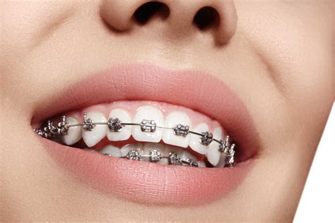 partes de los brackets metalicos|brackets de metal.